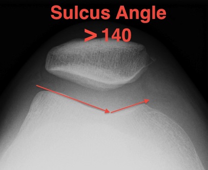PFJ Normal Sulcus Angle